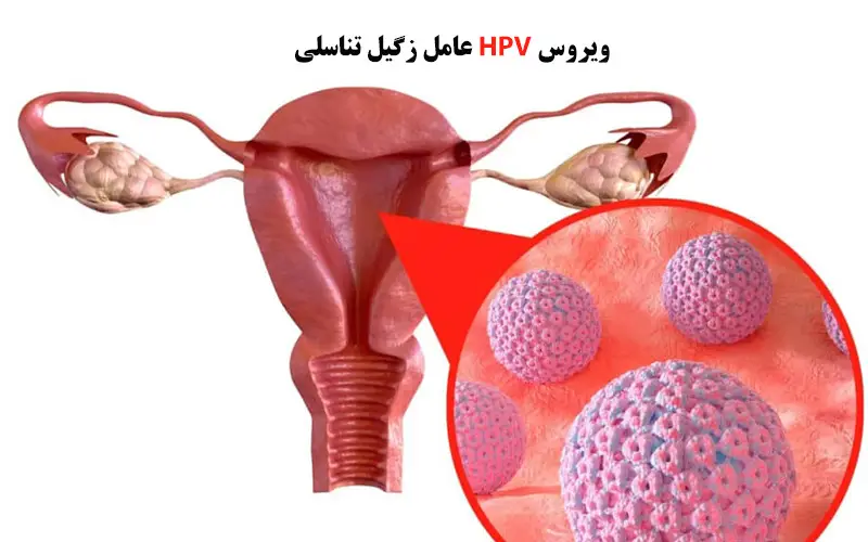 درمان زگیل تناسلی مردان و زنان